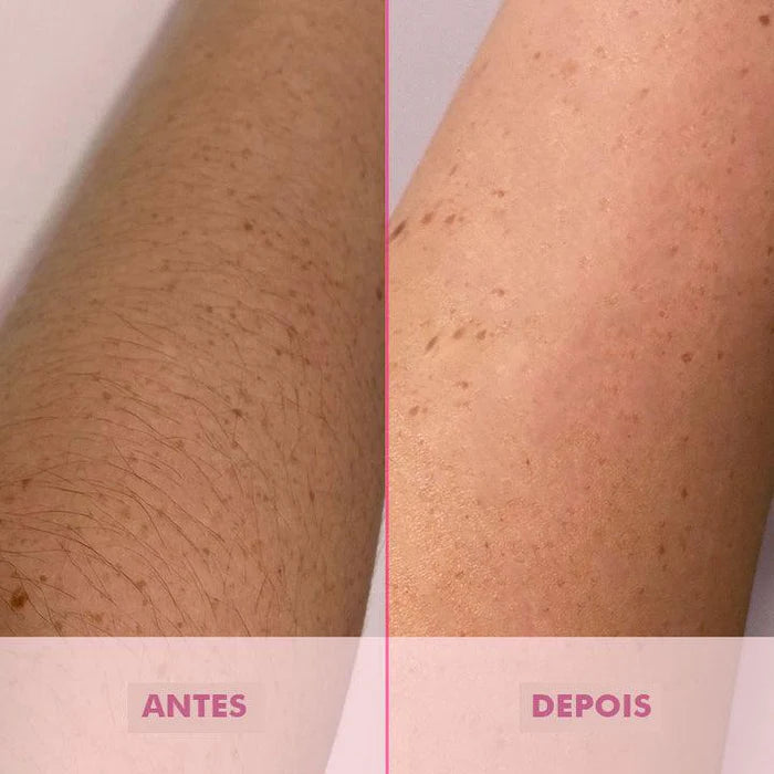 Depilador Definitivo com Tecnologia IPL